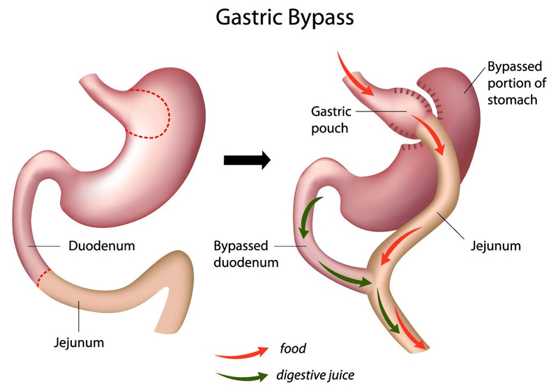 web-Gastric-Bypass
